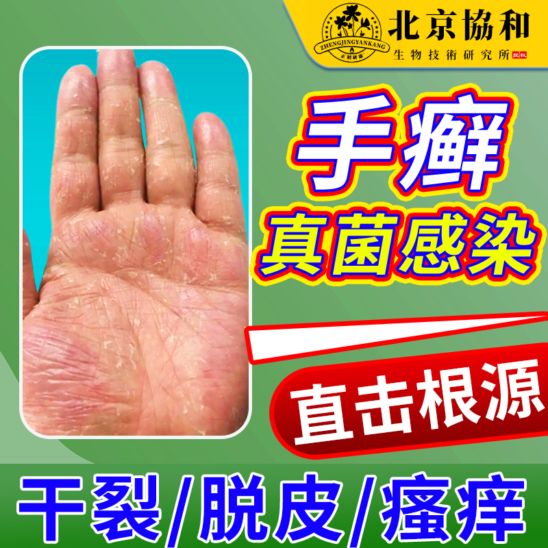 手癣膏脱皮干裂真菌感染手足癣湿疹去止痒根藓鹅掌风手气手指OA