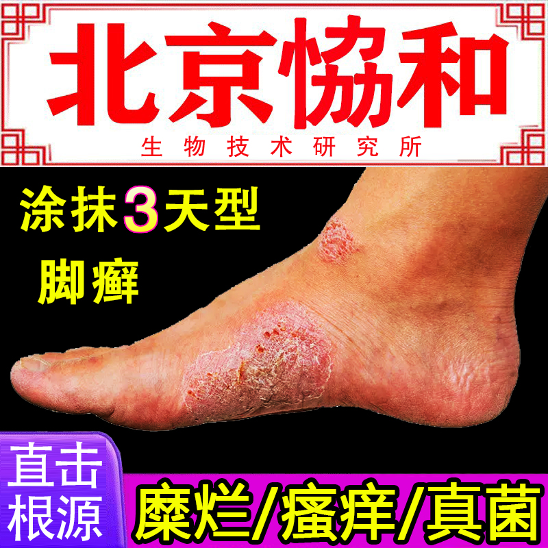 脚癣一次净脚气去止痒脚藓药房同售膏真菌感染根泡脚液脱皮足癣lx