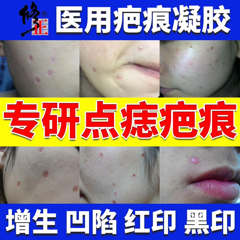 祛痣去痣疤痕修复膏脸上专用激光点痣后去红印疤痕贴除疤膏消印YS