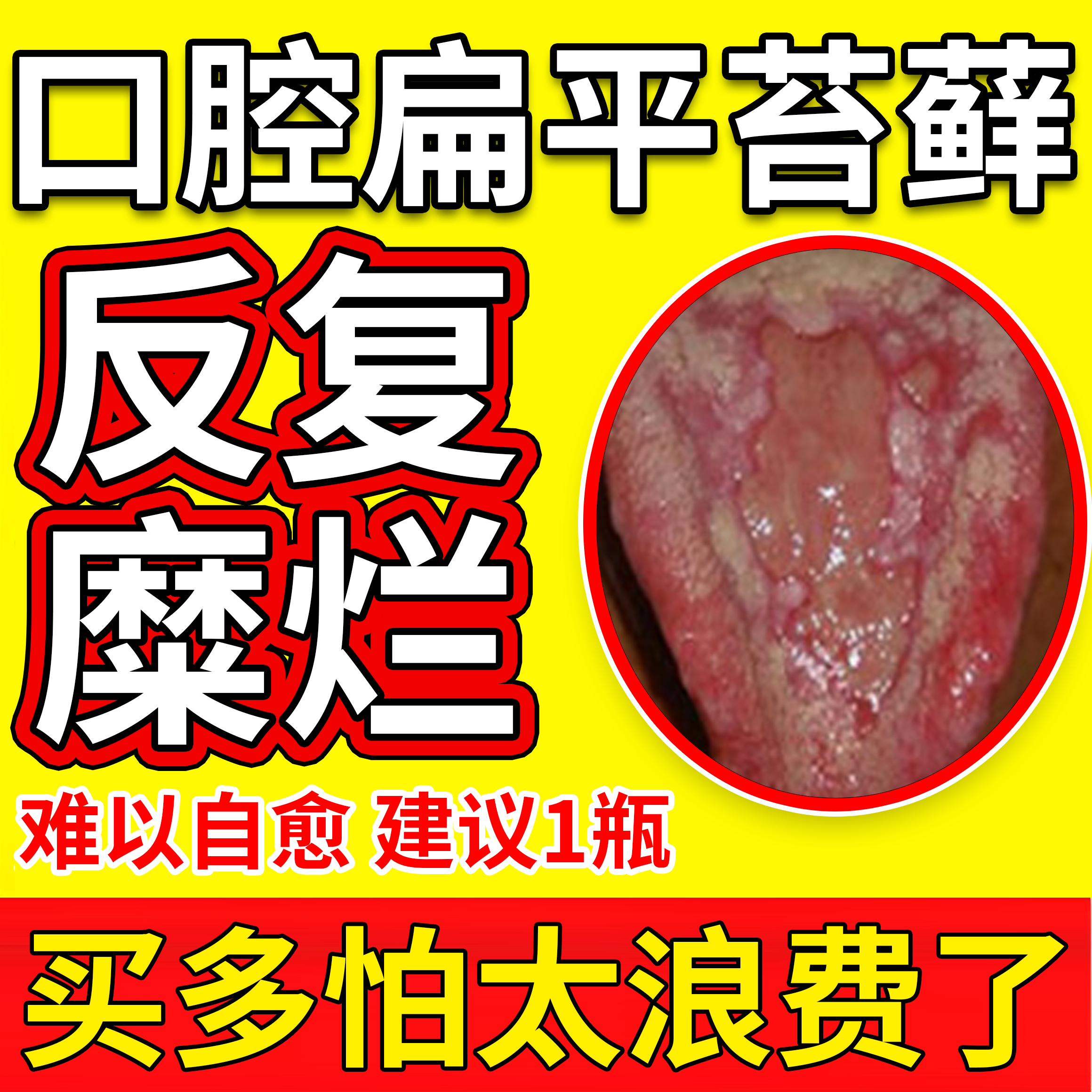 口腔扁平苔藓专用药治疗黏膜修复纤维化溃舌头中间有裂纹漱口水js
