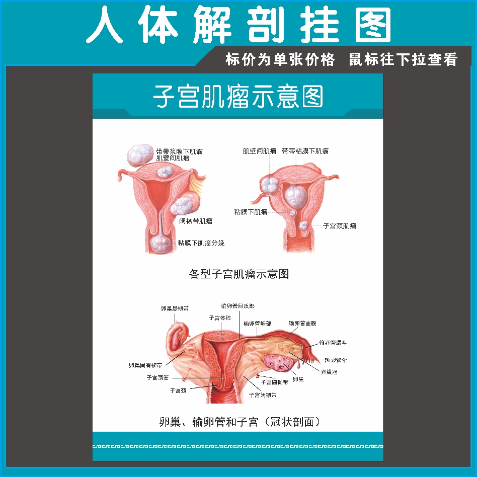 子宫肌瘤示意图海报人体解剖图海报展板 贴画 人体解剖生理学挂图