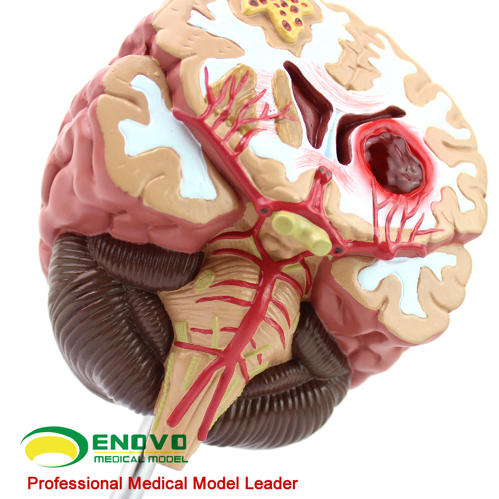 ENOVO颐诺医学脑卒中模型 大脑模型人体脑部疾病展示神经内外科脑中风脑溢血生命健康复教育急救护理医生培训