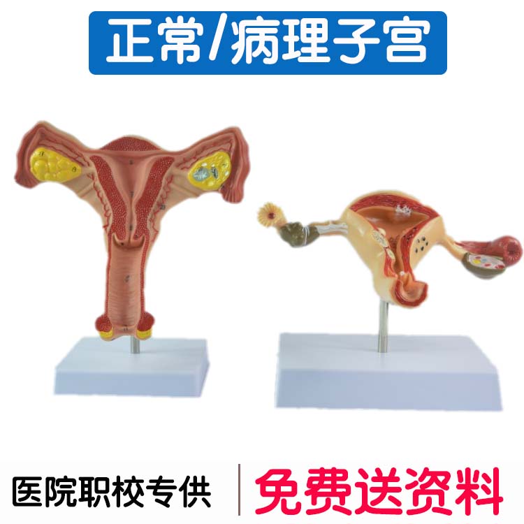 人体子宫解剖模型 女性生殖系统双侧卵巢子宫 正常/病理子宫对比
