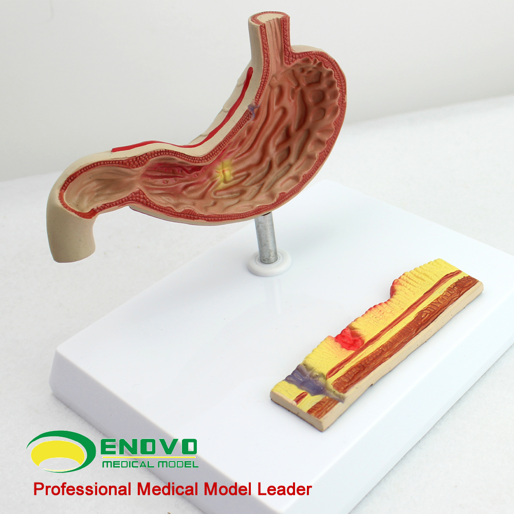 人体胃消化系统模型 ENOVO颐诺 消化科胃的病理变化过程